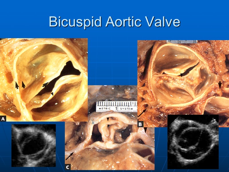 Bicuspid Aortic Valve